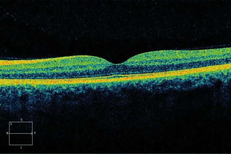 Example of AI fundus image analysis showing detailed retinal examination results