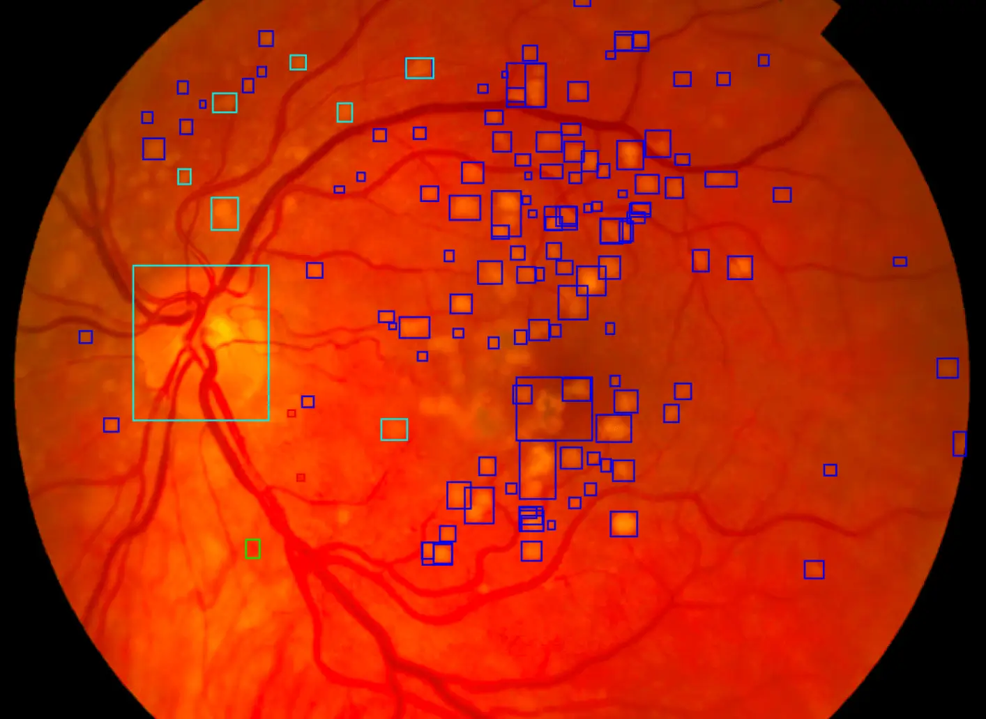 Example of AI fundus image analysis showing detailed retinal examination results